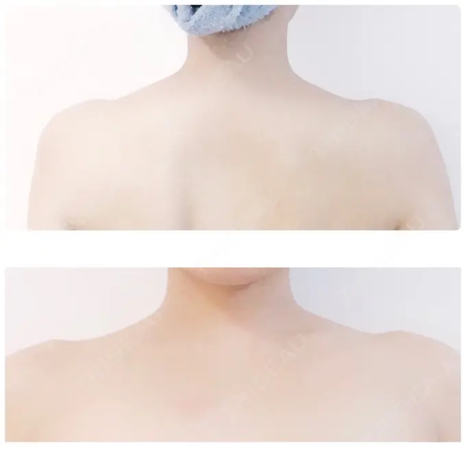 ボトックス（肩） ヴェルトラクリニック 大阪院 AFTER メイン用