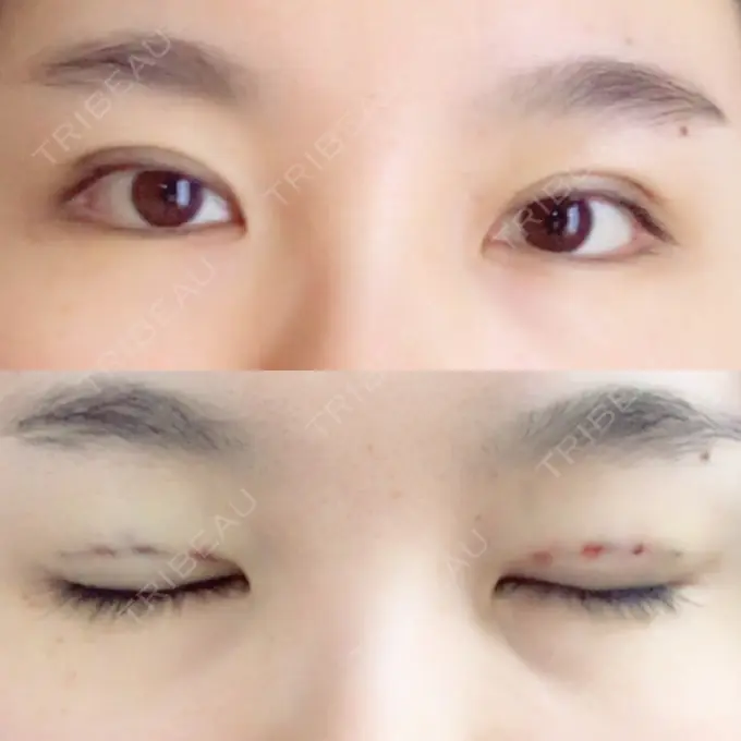 二重埋没 湘南美容クリニック 大阪あべの院 DAY 0 メイン用