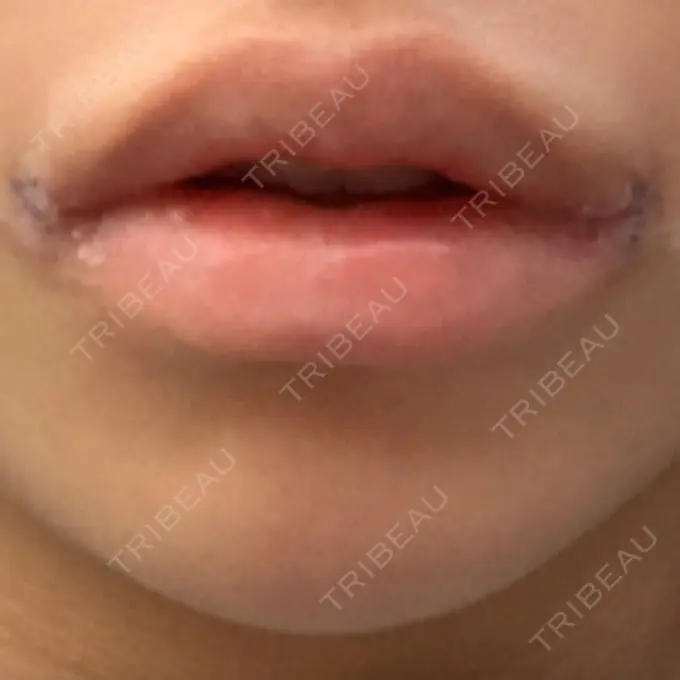 口角挙上 新宿ラクル美容外科クリニック 新宿院 DAY 6 メイン用