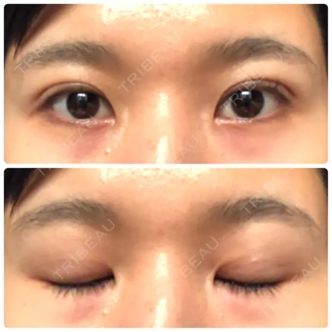 二重埋没 湘南美容クリニック 赤坂見附院 DAY 62 メイン用