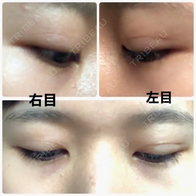 二重埋没 湘南美容クリニック 赤坂見附院 DAY 62 メイン用