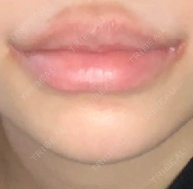 口角挙上 新宿ラクル美容外科クリニック 新宿院 DAY 7 メイン用