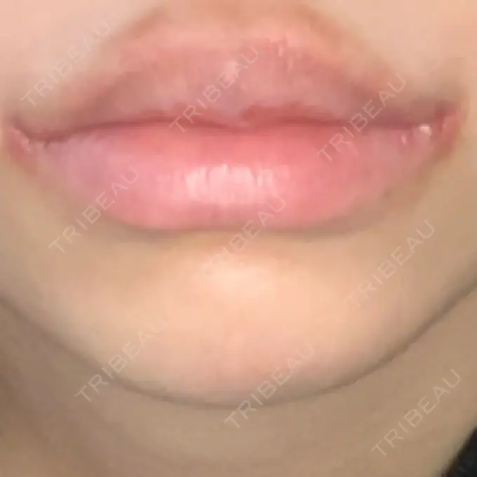 口角挙上 新宿ラクル美容外科クリニック 新宿院 DAY 7 メイン用