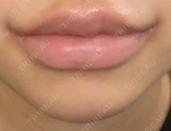 口角挙上 新宿ラクル美容外科クリニック 新宿院 DAY 8 メイン用