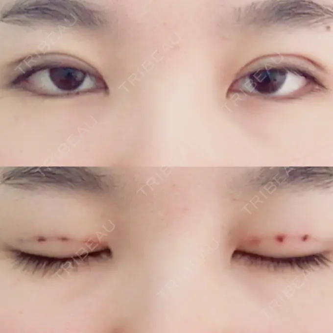 二重埋没 湘南美容クリニック 大阪あべの院 DAY 1 メイン用