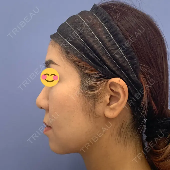 糸リフト / クマ治療 / バッカルファット除去 / 脂肪吸引（顔） / 下まぶたの脂肪取り / メーラーファット除去 湘南美容クリニック 秋葉原院 DAY 30 メイン用