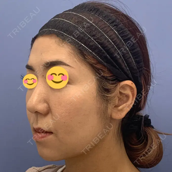 糸リフト / クマ治療 / バッカルファット除去 / 脂肪吸引（顔） / 下まぶたの脂肪取り / メーラーファット除去 湘南美容クリニック 秋葉原院 DAY 30 メイン用