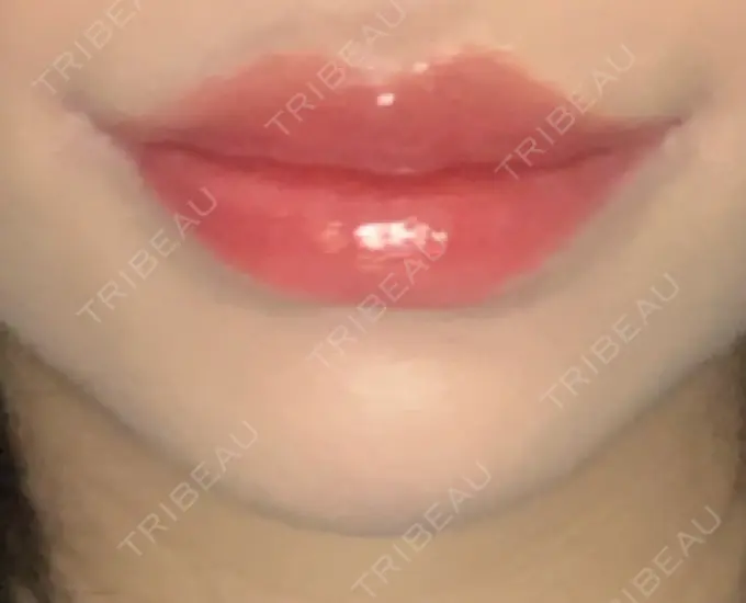 口角挙上 新宿ラクル美容外科クリニック 新宿院 DAY 10 メイン用