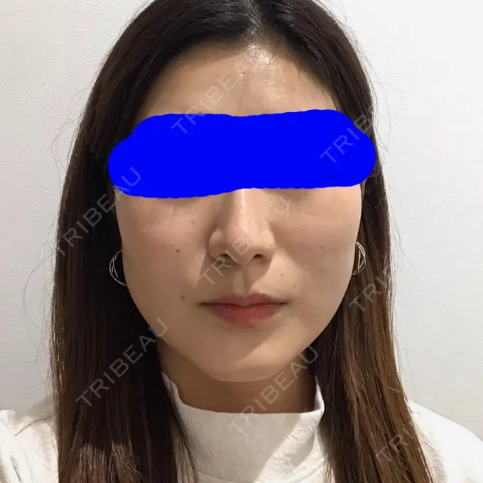 糸リフト / 脂肪吸引（顔） / メーラーファット除去 / ボトックス（エラ・小顔） 湘南美容クリニック 秋葉原院 DAY 33 メイン用