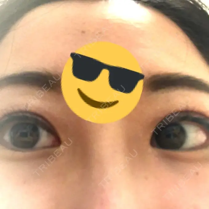 眼瞼下垂（切開） 船橋中央クリニック AFTER メイン用