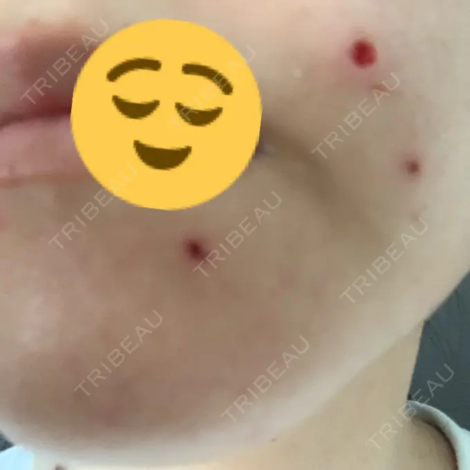 ほくろ・いぼ切除（肌） 医療法人美彩会 グランクリニック DAY 0 メイン用