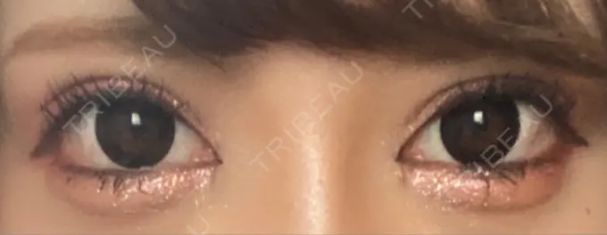 目頭切開 湘南美容クリニック 自由が丘院 DAY 38 メイン用