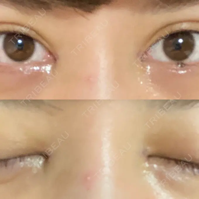 目頭切開 湘南美容クリニック 自由が丘院 DAY 38 メイン用