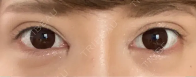 目頭切開 湘南美容クリニック 自由が丘院 DAY 39 メイン用