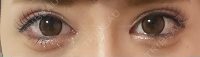 目頭切開 湘南美容クリニック 自由が丘院 DAY 40 メイン用