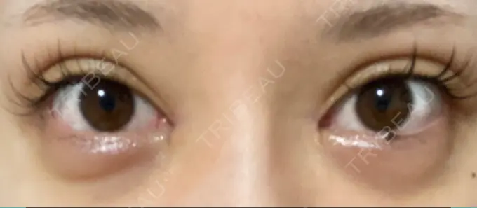 目頭切開 湘南美容クリニック 自由が丘院 DAY 49 メイン用