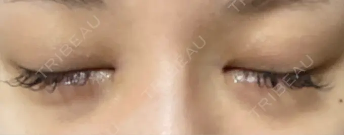 目頭切開 湘南美容クリニック 自由が丘院 DAY 49 メイン用