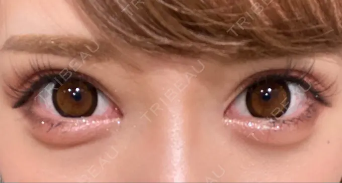 目頭切開 湘南美容クリニック 自由が丘院 DAY 69 メイン用