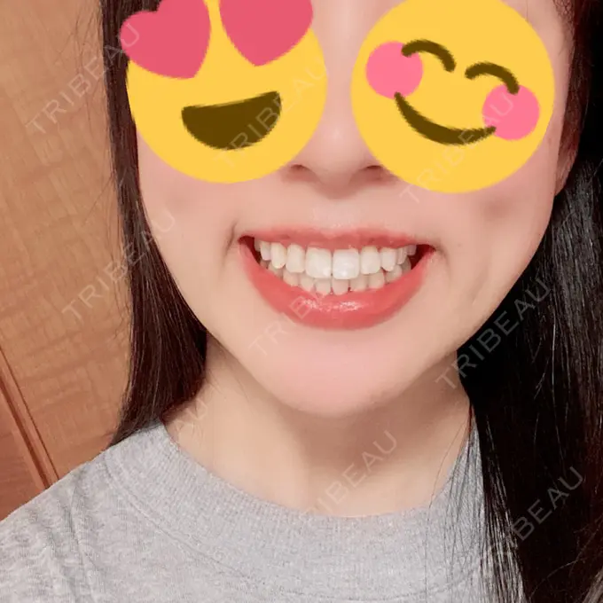 矯正（ワイヤー） アトラスタワー歯科 DAY 260 メイン用