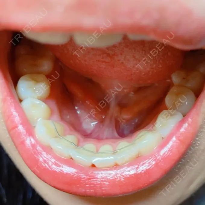 矯正（ワイヤー） アトラスタワー歯科 DAY 260 メイン用