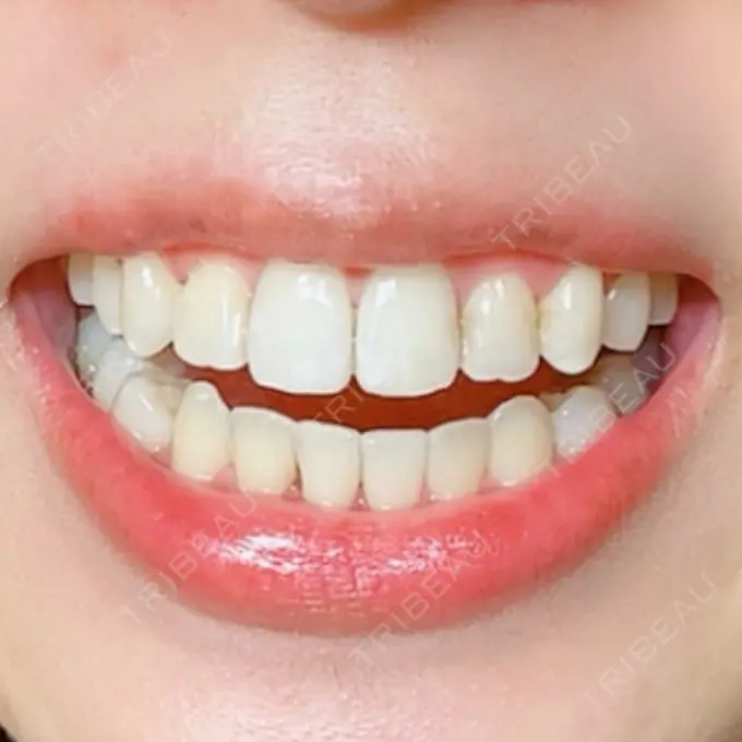 矯正（ワイヤー） アトラスタワー歯科 AFTER メイン用