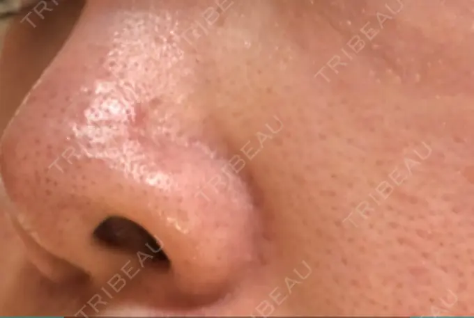 ピーリング（ニキビ・毛穴） / 美肌レーザー みやた形成外科・皮ふクリニック DAY 6 メイン用