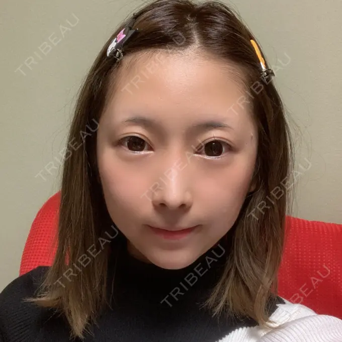 鼻尖形成（切開） / 小鼻縮小（切開） / 糸リフト / あごプロテーゼ / 骨削り（頬） / 脂肪吸引（顔） / 軟骨移植 ウォンジン（Wonjin）整形外科 DAY 367 メイン用