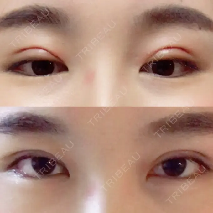 二重埋没 湘南美容クリニック 大阪あべの院 DAY 1 メイン用