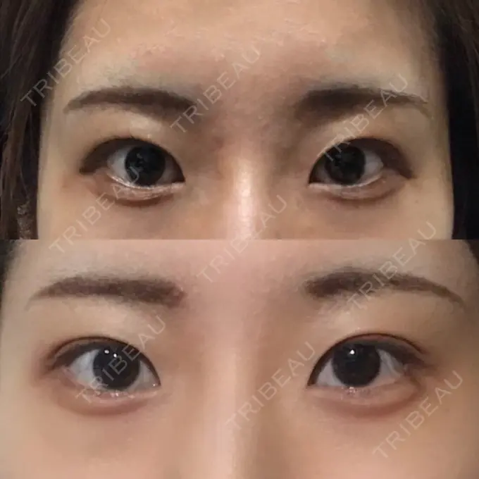 目尻切開 / タレ目形成・グラマラスライン（切開） A CLINIC（エークリニック） 銀座院 DAY 42 メイン用