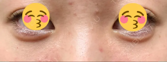 ヒアルロン酸注入（涙袋） / ヒアルロン酸注入（目の下） Wクリニック 心斎橋院 DAY 34 メイン用