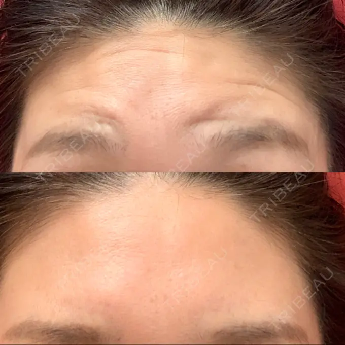 額を丸く / シワ取りボトックス 銀座3丁目・BANNAI美容クリニック AFTER メイン用