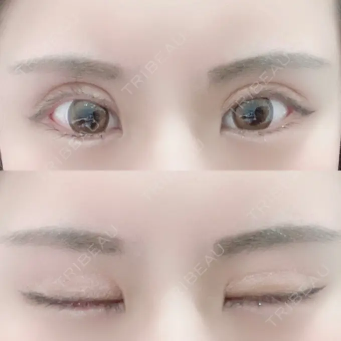 二重切開 / 目元修正 心斎橋コムロ美容外科クリニック DAY 168 メイン用