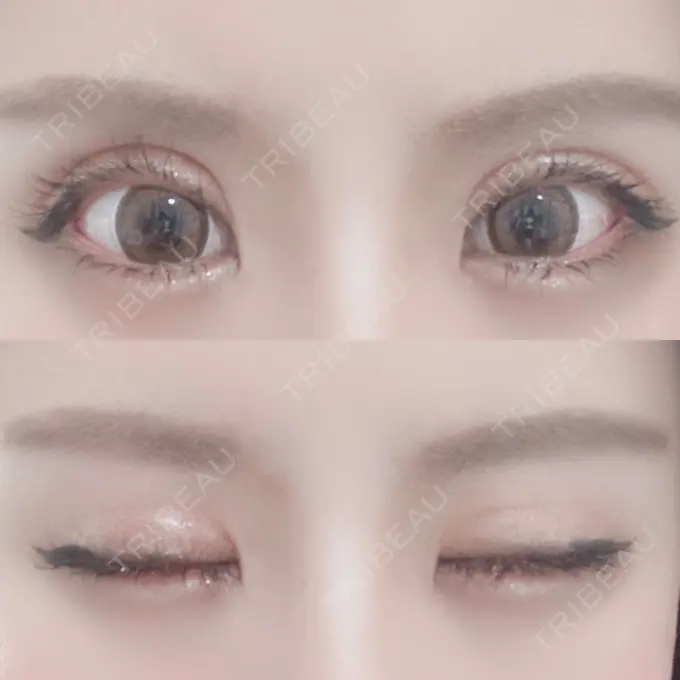 二重切開 / 目元修正 心斎橋コムロ美容外科クリニック DAY 169 メイン用