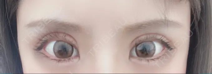 二重切開 / 目元修正 心斎橋コムロ美容外科クリニック AFTER メイン用