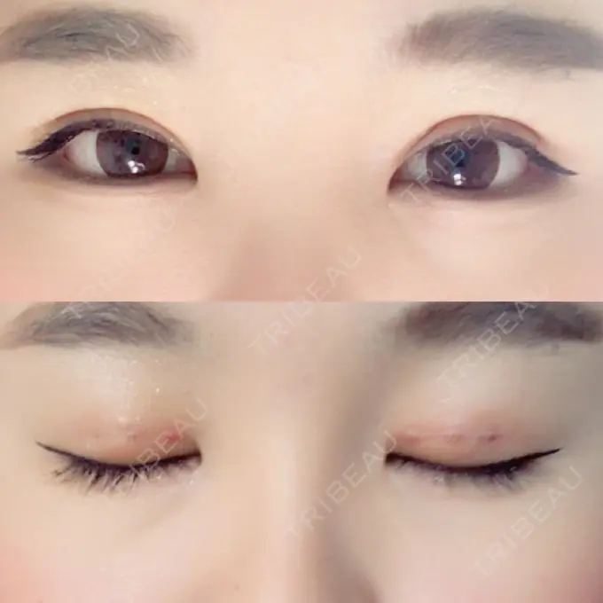 二重埋没 湘南美容クリニック 大阪あべの院 DAY 3 メイン用