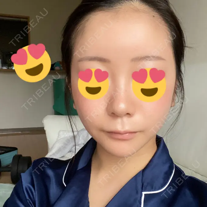 タレ目形成・グラマラスライン（切開） / 切開リフト ドクターゴールドマンクリニック 東京高輪院 DAY 61 メイン用