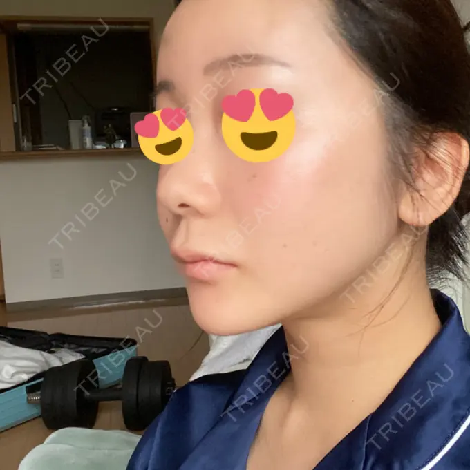 タレ目形成・グラマラスライン（切開） / 切開リフト ドクターゴールドマンクリニック 東京高輪院 DAY 61 メイン用