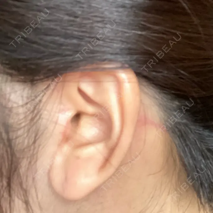 タレ目形成・グラマラスライン（切開） / 切開リフト ドクターゴールドマンクリニック 東京高輪院 DAY 61 メイン用