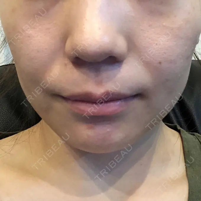 ボトックス（エラ・小顔） パールスキンクリニック天神 DAY 4 メイン用