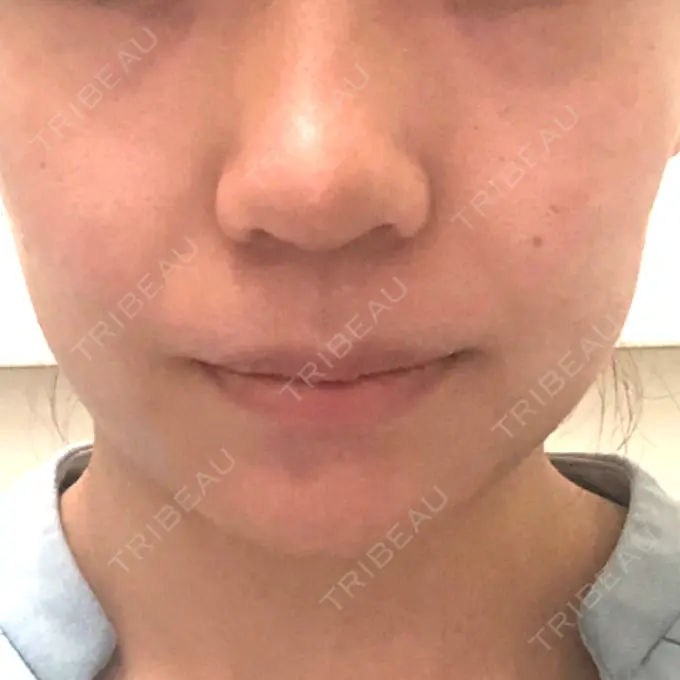 ボトックス（エラ・小顔） パールスキンクリニック天神 DAY 19 メイン用