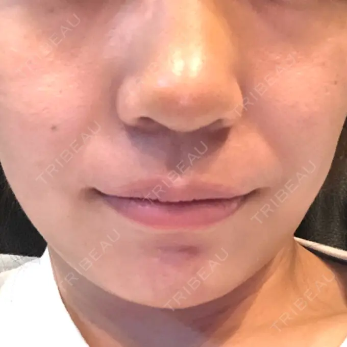 ボトックス（エラ・小顔） パールスキンクリニック天神 DAY 67 メイン用