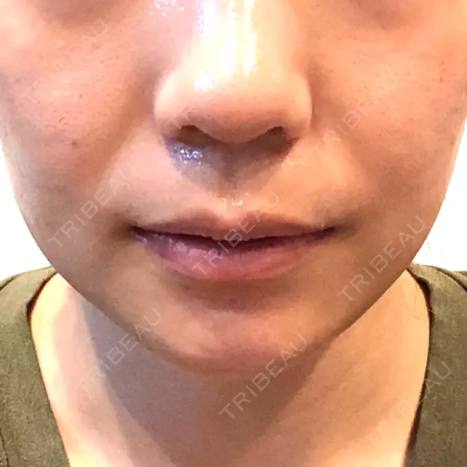 ボトックス（エラ・小顔） パールスキンクリニック天神 DAY 84 メイン用