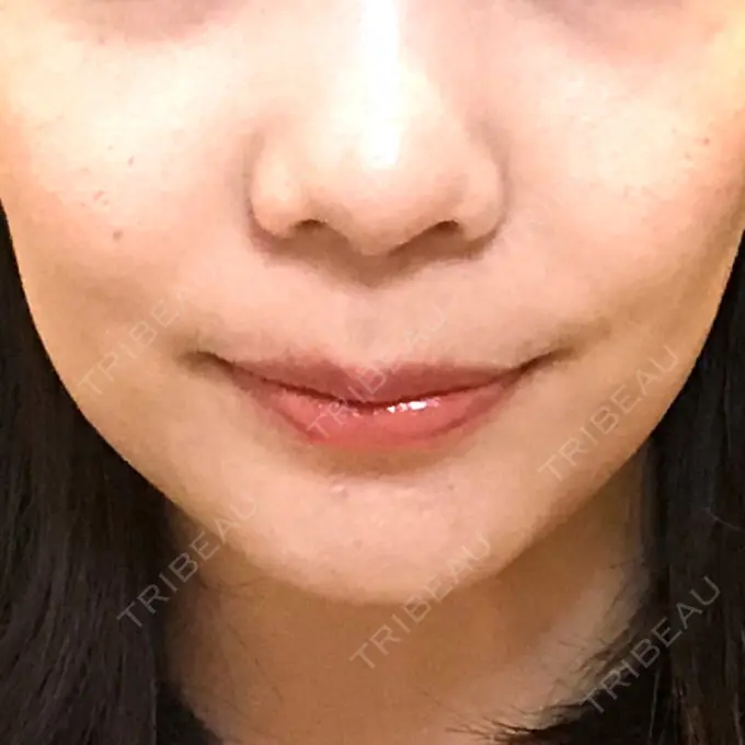 ボトックス（エラ・小顔） パールスキンクリニック天神 DAY 96 メイン用