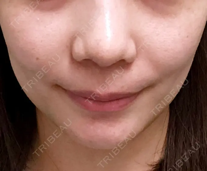 ボトックス（エラ・小顔） パールスキンクリニック天神 DAY 106 メイン用