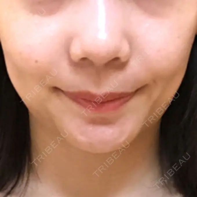 ボトックス（エラ・小顔） パールスキンクリニック天神 DAY 117 メイン用