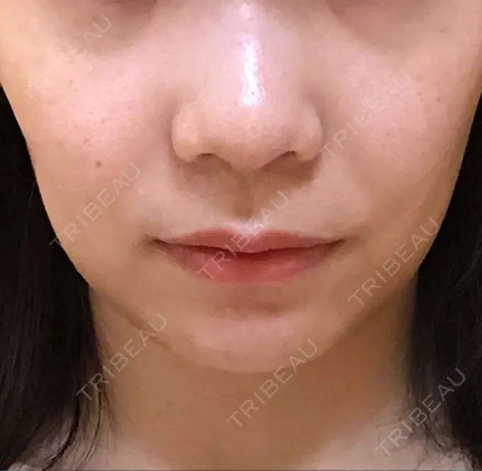 ボトックス（エラ・小顔） パールスキンクリニック天神 AFTER メイン用