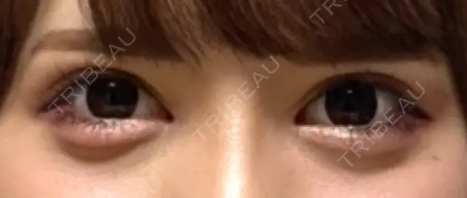 目頭切開 湘南美容クリニック 自由が丘院 AFTER メイン用