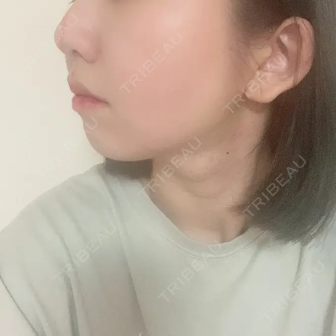 糸リフト / 肌ヒアルロン酸注入（たるみ・シワ改善） / ボトックス（エラ・小顔） TCB東京中央美容外科 新宿東口院 DAY 6 メイン用