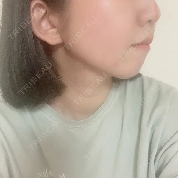 糸リフト / 肌ヒアルロン酸注入（たるみ・シワ改善） / ボトックス（エラ・小顔） TCB東京中央美容外科 新宿東口院 DAY 6 メイン用