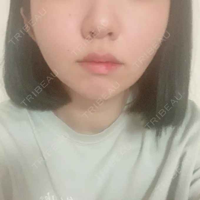 糸リフト / 肌ヒアルロン酸注入（たるみ・シワ改善） / ボトックス（エラ・小顔） TCB東京中央美容外科 新宿東口院 DAY 6 メイン用